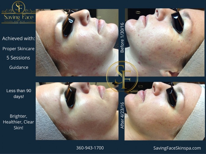 Acne Before-After