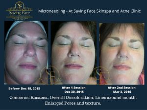 microneedling