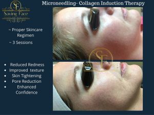 microneedling