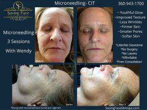 microneedling