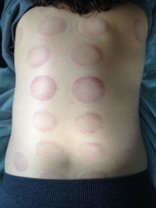 cupping olympia