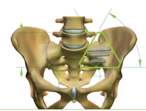 The sacrum is the keystone of the body providing strength and stability. Photo credit:SI-BONE Implant Sytems