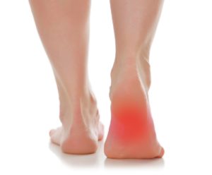 plantar fasciitis