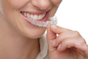 Invisalign