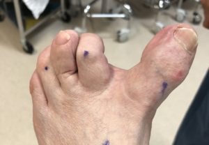 Washington Orthopaeidic Dujela Bunions Over-corrected bunion