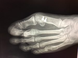 Washington Orthopaeidic Dujela Bunions Recurrent bunion