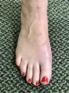 Washington Orthopaeidic Dujela Bunions Three month follow up