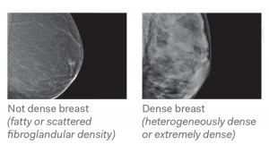 TRA Medical Imaging Breast Density