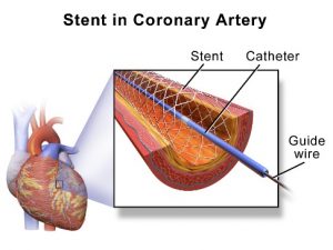 Dr Ankeney Kaiser Permanente stents 1