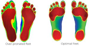 360 chiropractic Lacey Over pronated feet vs Optimal Feet