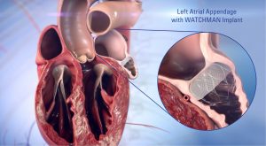 digital photo of a heart with the watchman device inserted