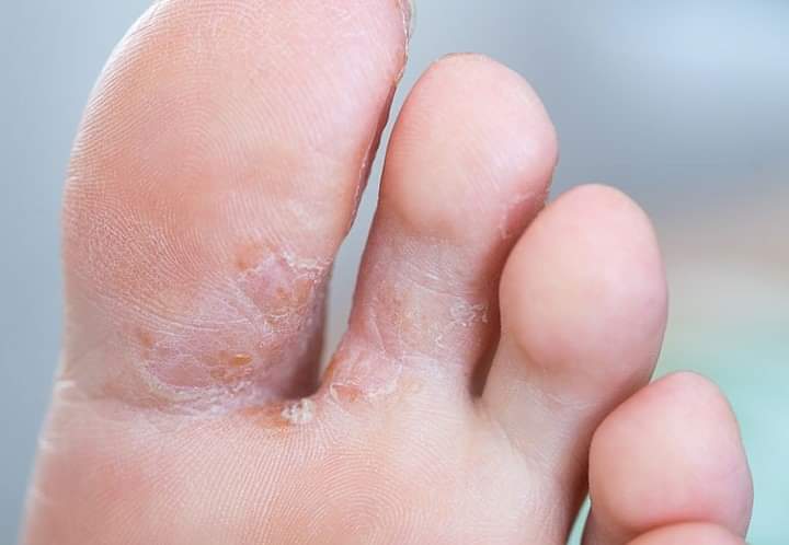 Home Care for an Ingrown Toenail: South Sound Foot & Ankle: Podiatric  Medicine and Surgery