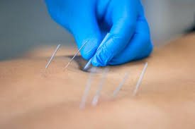 a person's bare back getting dry needles inserted